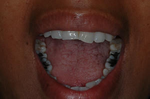 CR Before